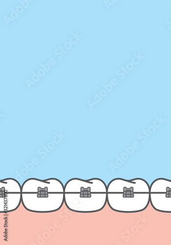 Blank banner Damon Q braces teetth illustration vector on blue background. Dental concept.