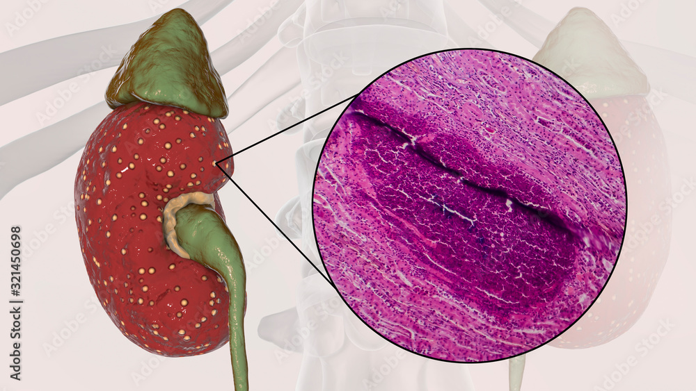 Acute pyelonephritis, 3D illustration showing gross morphology with ...