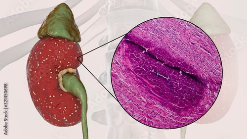 Acute pyelonephritis, 3D illustration showing gross morphology with focal small abscesses in kidney tissue and light micrograph showing histopathology of microabscesses photo