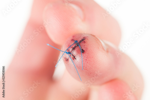 A deep wound is sewn on the middle finger of the hand photo
