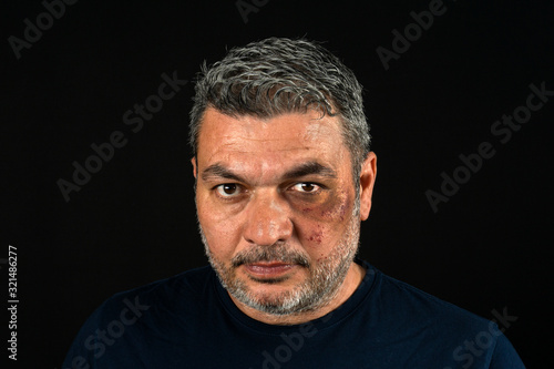 portrait of mature man with injured face