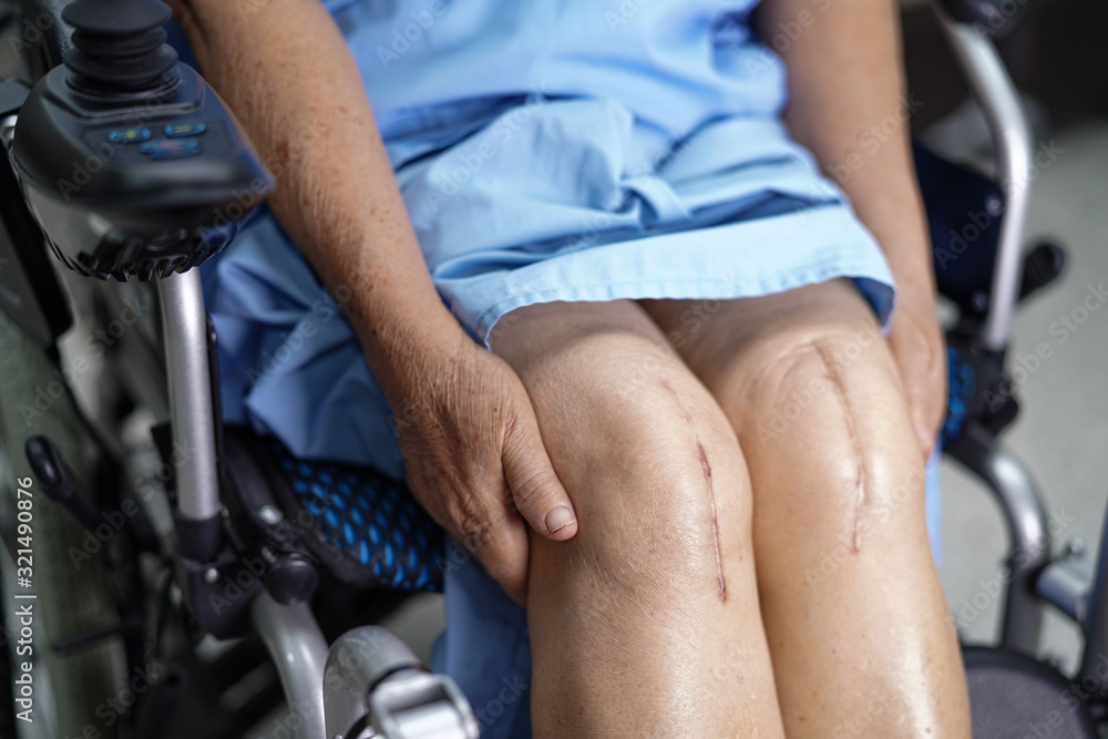 Obraz premium Asian senior or elderly old lady woman patient show her scars surgical total knee joint replacement Suture wound surgery arthroplasty on wheelchair in nursing hospital ward.