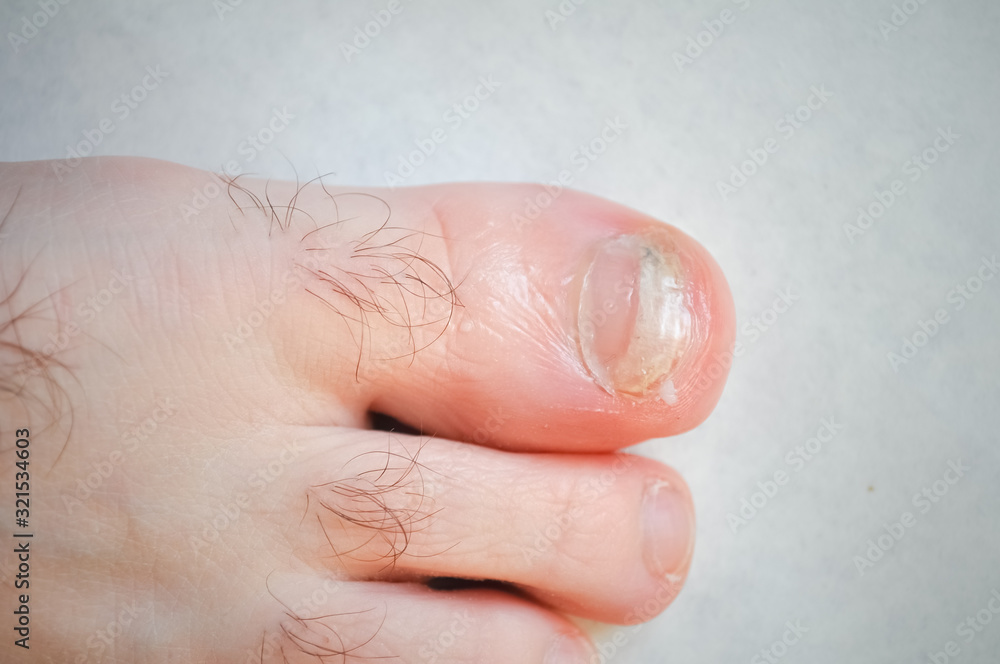 damaged a large nail on the male foot damaged a large nail on the male foot
