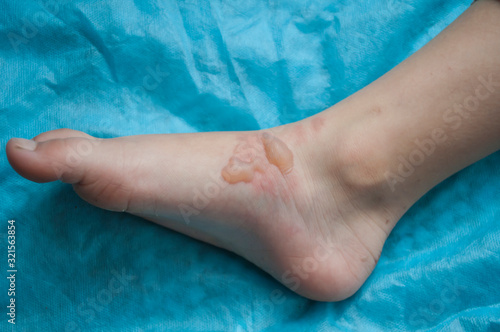 swelling on the child's foot from scalding