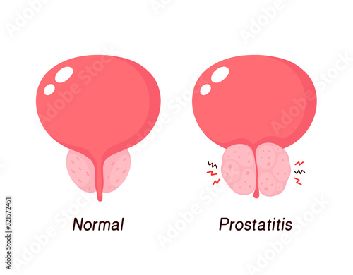 Normal prostate and benign prostatic hyperplasia