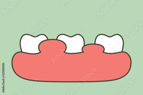 unhealthy teeth because gingivitis or gum disease with abscess, gum is swollen - dental cartoon vector flat style