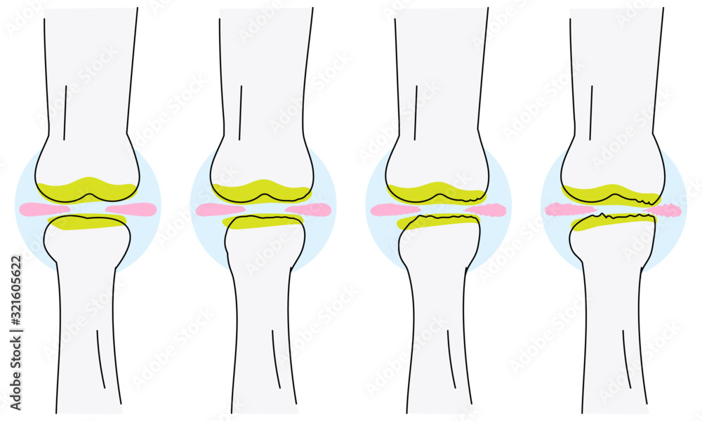 変形性膝関節症で半月板がすり減っていくベクターイラスト Stock Vector Adobe Stock