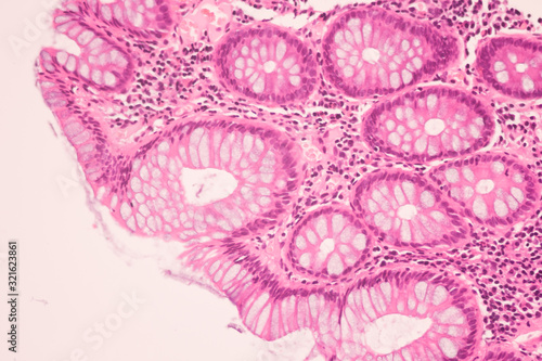 Obraz na plátne View in microscopic of ductal cell carcinoma, adenonocarcinoma from human breast cancer, tissue section by H and E stain