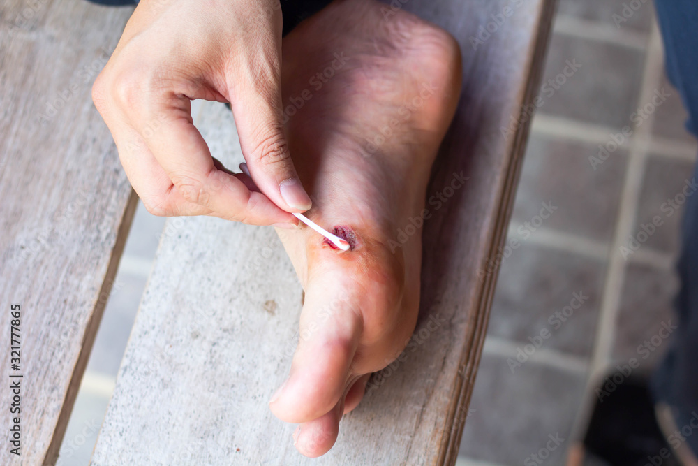 Sores on the feet of people. Trauma caused by an accident. Apply a