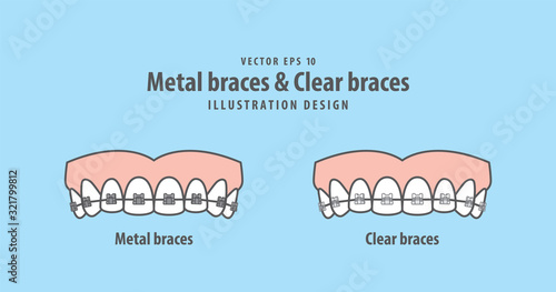 Metal braces teeth & Clear braces teeth (Upper) illustration vector on blue background. Dental concept.