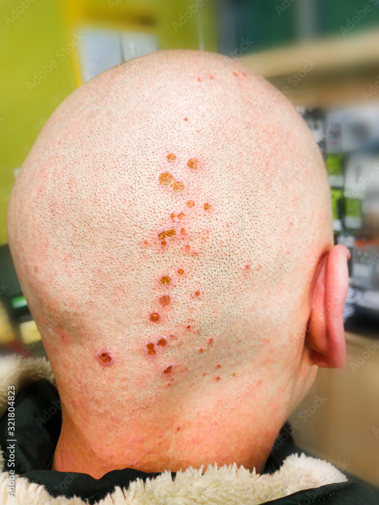 Chemical burns on the head. Wounds after hair dyeing. Chemistry