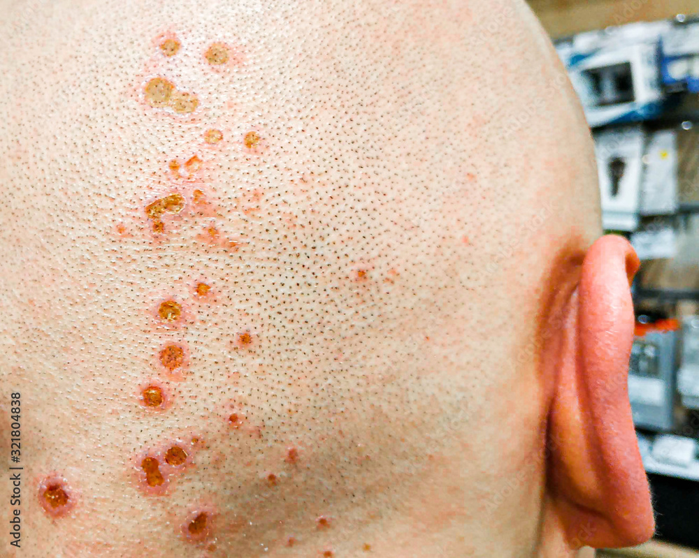 Chemical burns on the head. Wounds after hair dyeing. Chemistry