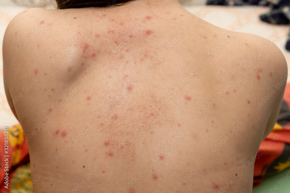 Upper back of young woman contracted chickenpox and red rash spilled on her  skin Stock Photo