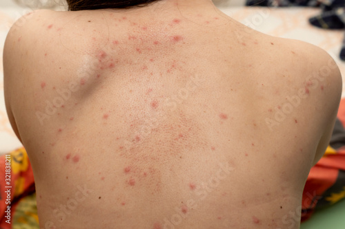 Fotografía Upper back of young woman contracted chickenpox and red rash spilled on her skin