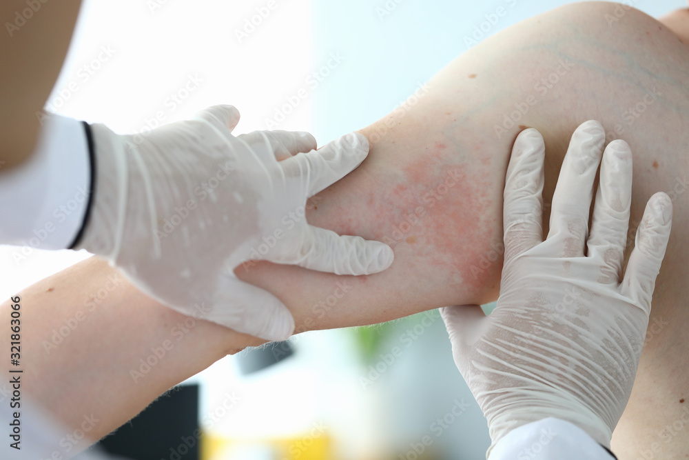 Closeup examination by doctor allergic rash. Doctor examines patient skin. Hands in medical