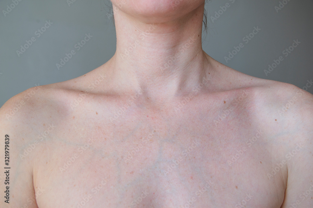 pigmentation-of-spots-on-the-chest-and-shoulders-stock-photo-adobe-stock