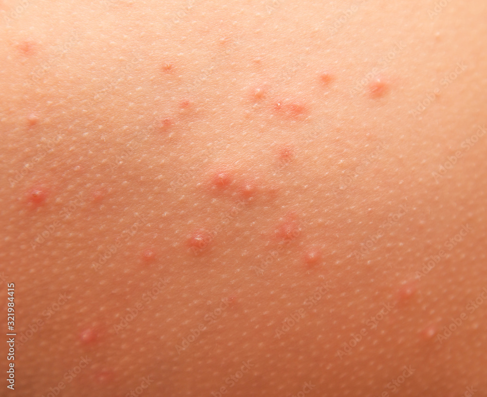 Fototapeta premium allergic rash on children's skin