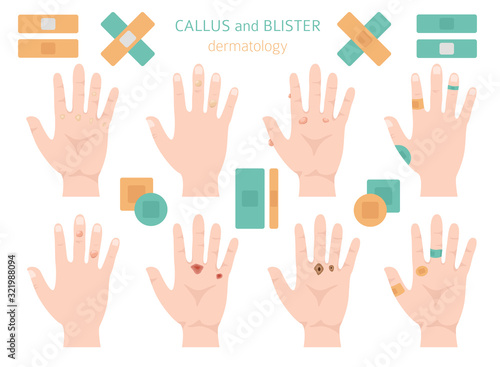Callus, corn and blister feet and hands. Dermatology. Medical desease infographics collection