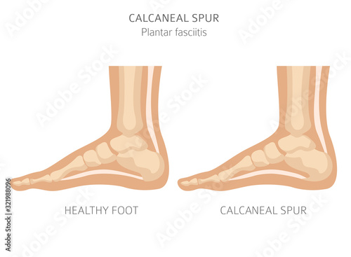 Calcaneal spur. Plantar fasciitis set. Medical desease infographics collection