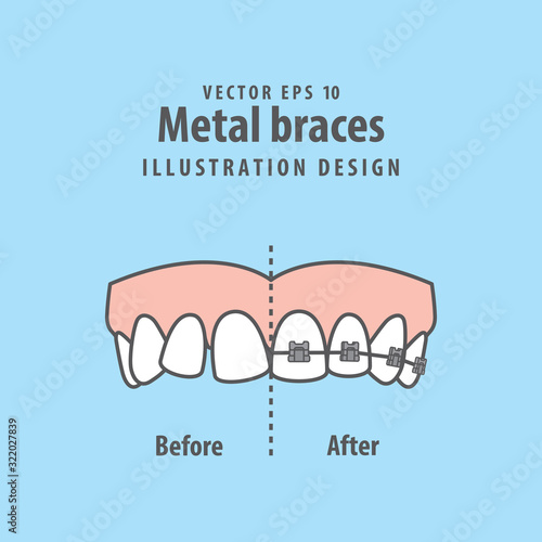 Compare upper teeth Metal braces before and after illustration vector on blue background. Dental concept.