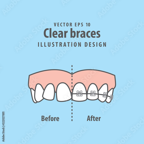 Compare upper teeth Clear braces before and after illustration vector on blue background. Dental concept.