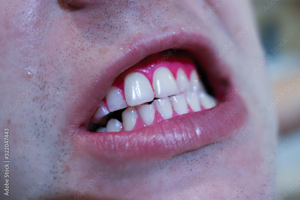 Obraz premium Close up studio shot isolated on grey background african guy pointing finger to white shiny toothy smile, concept of teeth whitening, dental care, dentistry services and products advertisement concept