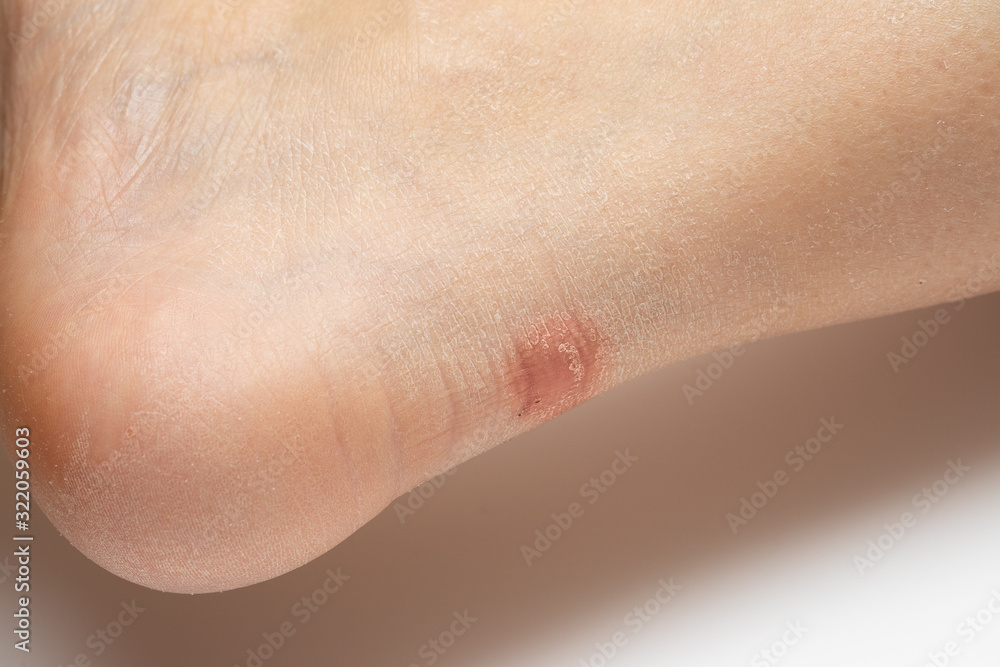 Broken and sore blister on the heel of a Caucasian lady. Problem due to inadequate footwear