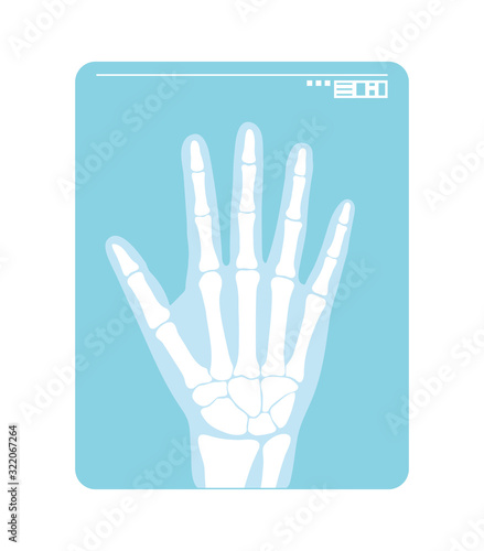 Radiogram of hand. X-ray or roentgenogram. Vector illustration of radiograph