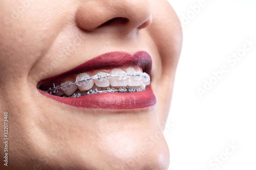 Close up of a pretty smile with braces
