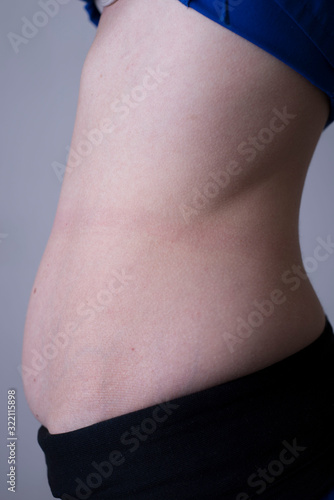 one of the stages of postpartum excess growth of adipose tissue and skin of the abdomen, after surgery during childbirth. Close-up belly of a girl with a postpartum belly