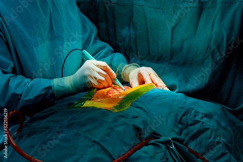 Surgeon surgery and team perform thoracic surgery in case lung cancer