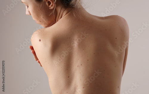Checking benign moles : Woman with birthmarks on her back photo