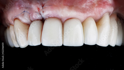 mounted dental crown at the site of tooth implantation