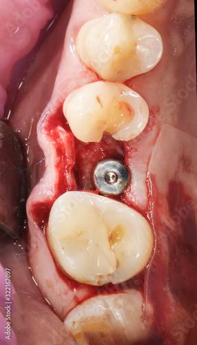 Dental implant placed in the bone before suturing the gums.