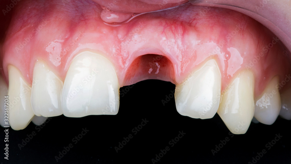 gum without central tooth after implant placement