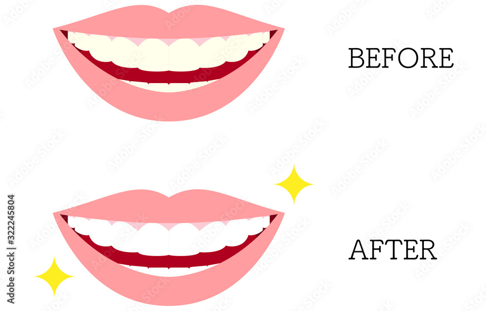 審美歯科 黄ばんだ歯と白い歯のイラスト Stock Vector Adobe Stock