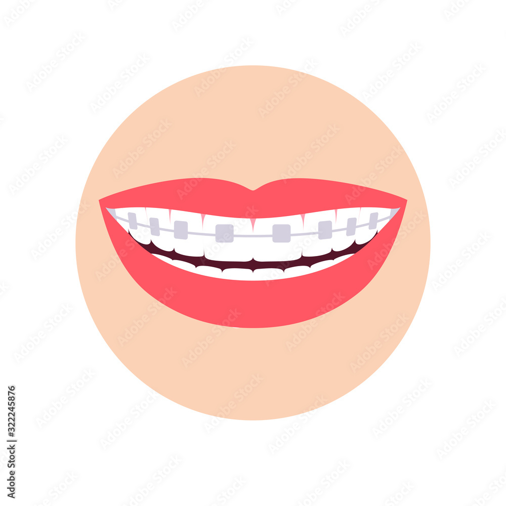 Orthodontic braces on teeth. Smile isolated on a white background. Vector illustration Orthodontic braces on teeth. Smile isolated on a white background. Vector illustration