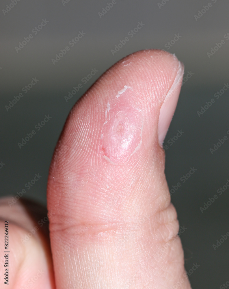 finger damage in the form of corns finger damage in the form of corns