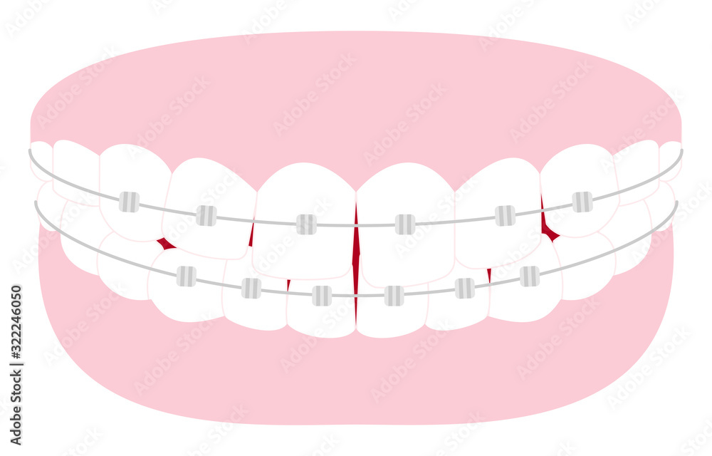 審美歯科 歯列矯正のイラスト 歪んだ歯並びとメタルブラケット Stock Vector Adobe Stock