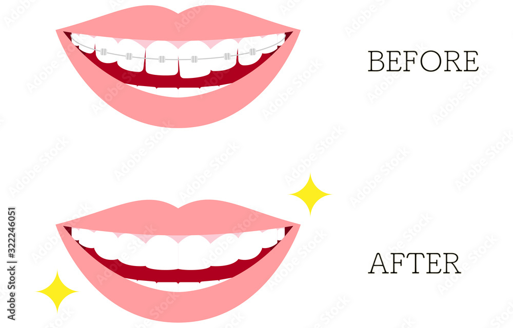 審美歯科 歯列矯正のイラスト 歪んだ歯並びと綺麗な歯並び メタルブラケットつき Stock Vektorgrafik Adobe Stock