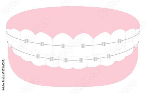 審美歯科、歯列矯正のイラスト：綺麗な歯並びとメタルブラケット
