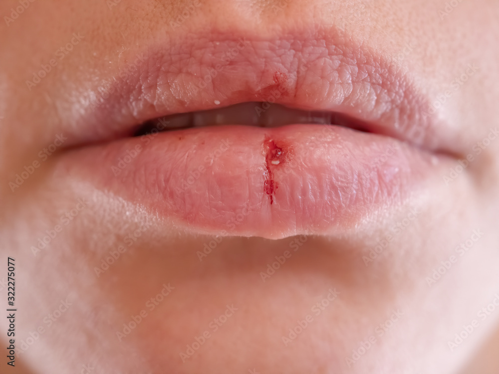 Close-up pale female lips cracked from frost, wind, lack of vitamins. Herpes disease virus wound. Lips need hygiene. Mature woman 35 years oldsuffering from herpes Close-up pale female lips cracked from frost, wind, lack of vitamins. Herpes disease virus wound. Lips need hygiene. Mature woman 35 years oldsuffering from herpes