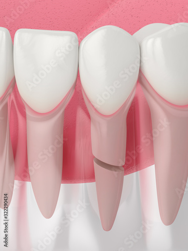 3d render of jaw with cracked tooth root photo