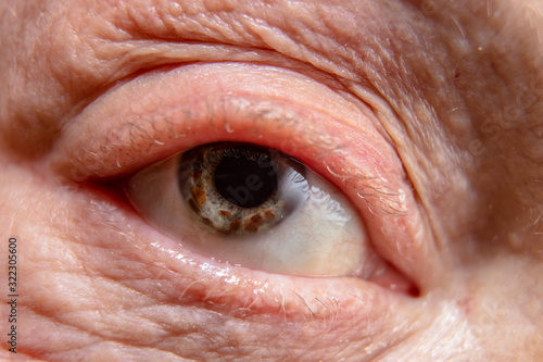 The blue eye of an old man with many brown specks on the iris.