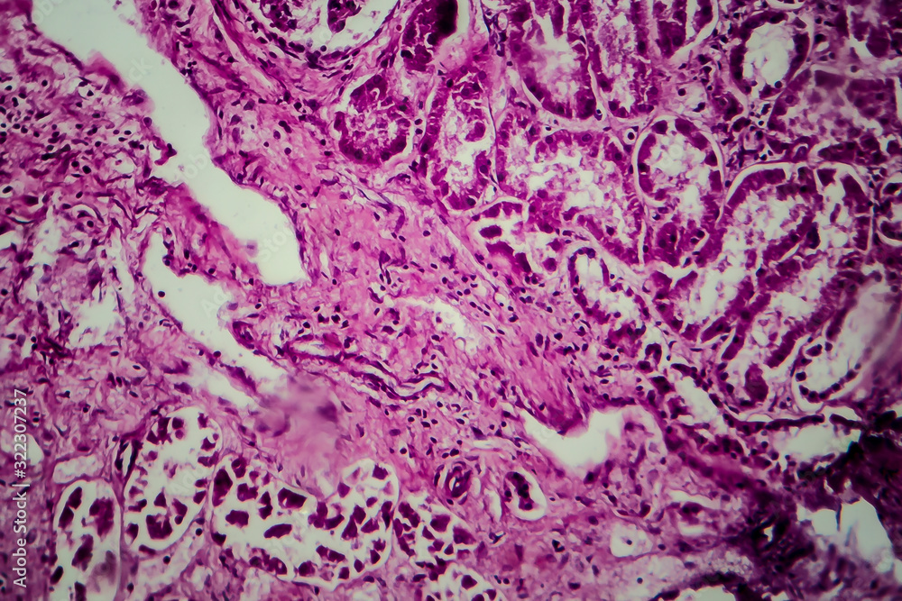 Diffuse sclerosing glomerulonephritis Diffuse sclerosing glomerulonephritis