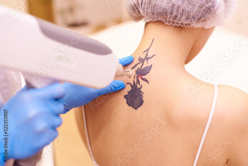 Laser tattoo removal in a cosmetology clinic. photo