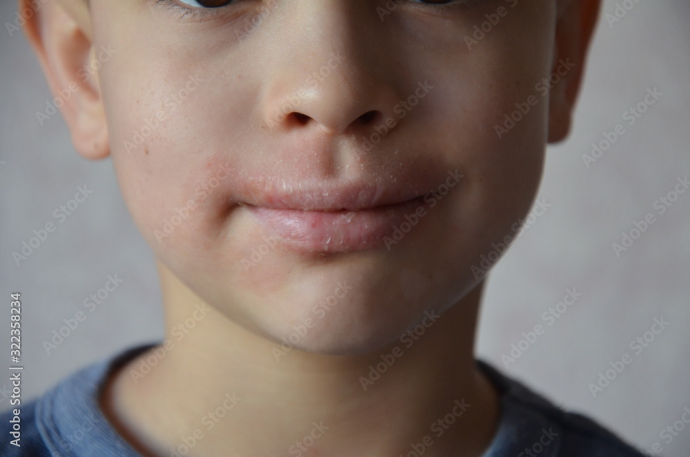 close up lips and face of a schoolboy or teenager with allergies. Lip irritation. Portrait of smiling child sneezing, scratching nose, seasonal allergy, modern illness close up lips and face of a schoolboy or teenager with allergies. Lip irritation. Portrait of smiling child sneezing, scratching nose, seasonal allergy, modern illness