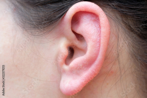 Girl's ear close-up. Sore red ear from allergies. Problems associated with auricle disease.