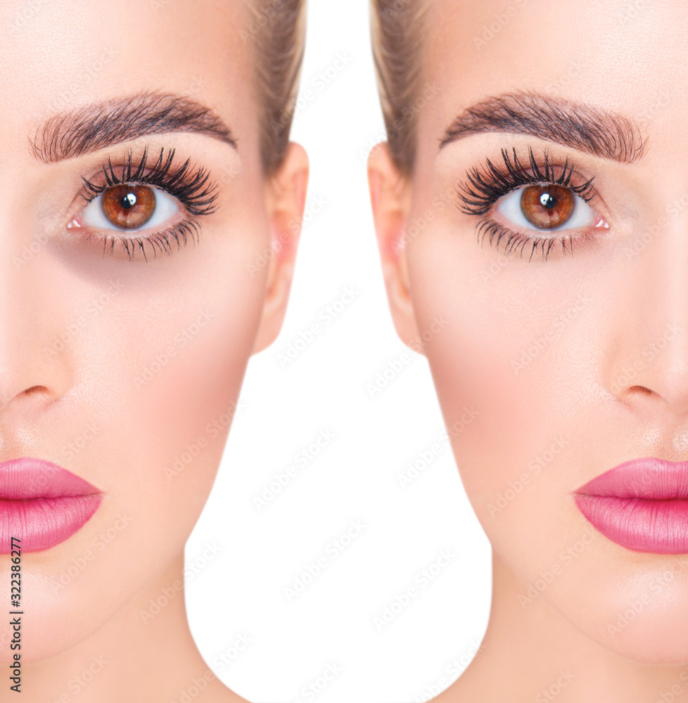 Young woman with bruises under eyes before and after treatment.