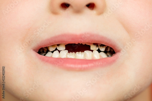 Kid patient open mouth showing cavities teeth decay. Close up of unhealthy baby teeth. Dental medicine and healthcare - human patient open mouth showing caries teeth decay